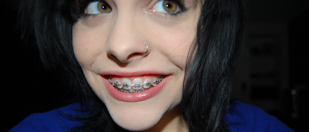 How To Remove Braces At Home